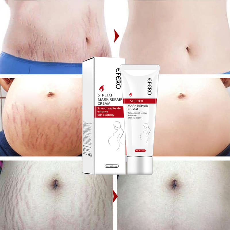 Stretch Mark Removal Cream