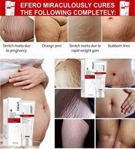 Stretch Mark Removal Cream